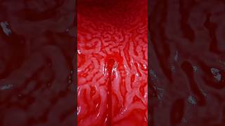 Bleeding Gastric Ulcer Causes Symptoms and Treatment health anatomy gastricproblems ulcers [upl. by Asilanom535]