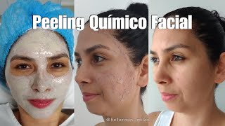 Peeling Químico Facial  Renueva tu Piel [upl. by Lacee]