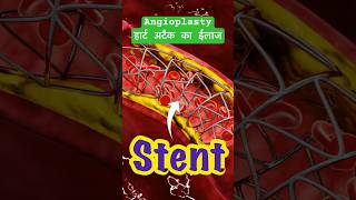 Angioplasty angioplasty heartattack facts ytshortsindia science [upl. by Matthieu45]