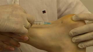 Plantar fasciitis injection [upl. by Hein]