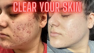 HOW I CLEARED MY ACNE  Curology Differin Mighty Patch LIFESTYLE [upl. by Karmen]