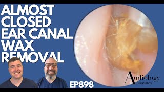 ALMOST CLOSED EAR CANAL WAX REMOVAL  EP898 [upl. by Lilli]