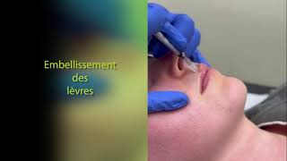 L’EMBELLISSEMENT DES LÈVRES  LIP ENHANCEMENT [upl. by Storer]