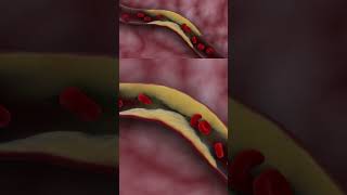 Thrombotic ischemic stroke doctor science biology film4health hospital [upl. by Tacy]