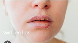 swollen lips causes By DrAbdul Majeed [upl. by Alleroif]