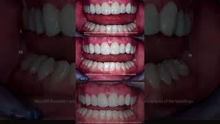 Video Preview Creating a Smile Makeover Treatment Plan with Composite Bonding [upl. by Amsab]