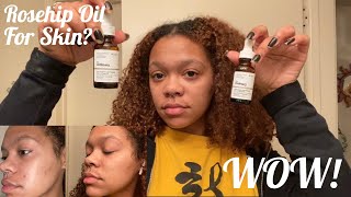 I Tried Rosehip Seed Oil On My Face For 30 Days  The Ordinary  Hyperpigmentation [upl. by Ryter]