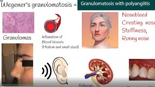 Wegeners granulomatosis  Granulomatosis with polyangiitis  Symptoms and causes [upl. by Gnah676]