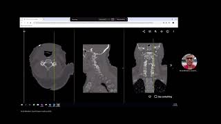 Vertebral Artery Dissection [upl. by Meakem]