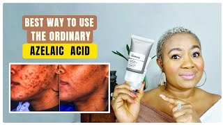 The Ordinary Azelaic Acid Suspension 10 Review Best Way To Use For Clear Skin [upl. by Pizor114]