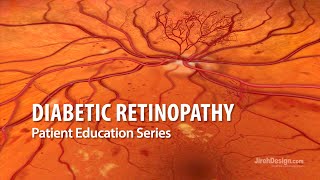 Diabetic Retinopathy [upl. by Gaddi]