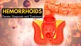 Hemorrhoids or Piles CausesSigns and symptoms Diagnosis and Treatment [upl. by Varden]