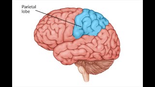 Parietal lobe stroke [upl. by Hcelemile]