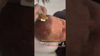 Haar Behandlung mit Mesotherapie oder PRP Eigenbluttherapie [upl. by Suoicerp]