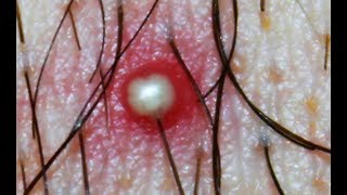 Whitehead or Ingrown Hair What is this Dr Poppers Pimples Cysts Boils [upl. by Amling]