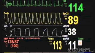 Bronchospasm 2  Patient Monitor [upl. by Ateloiv694]