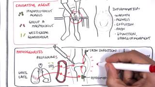 Septic Arthritis  Overview causes pathophysiology treatment [upl. by Haroun139]