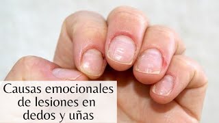 ¿Qué causa las lesiones en dedos y uñas [upl. by Eiffub]