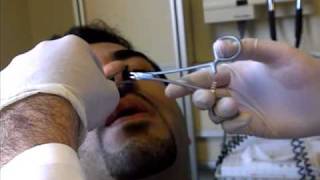 Nose Splint Removal in ED [upl. by Galen]