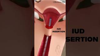 IUD insertion precautions pregancy nclex nurses nursing iud uterus child birth control [upl. by Gent]