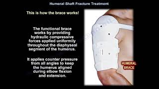 Humeral Shaft Fracture Treatment  Everything You Need To Know  Dr Nabil Ebraheim [upl. by Paule146]