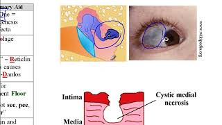 USMLE ACE Video 25 Collagen Synthesis and Disorders Types IIV and FibrillinRelated Conditions [upl. by Eniak]