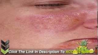 How to Cure Psoriasis Fast [upl. by Dust479]