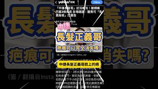 中捷「長髮正義哥」臉上的疤，可以完全消除嗎？shorts 中捷 [upl. by Nohtahoj]