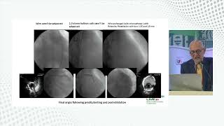 Calcium Debulking Strategy using Rotational Atherectomy by Dr Imad Sheiban [upl. by Berte]