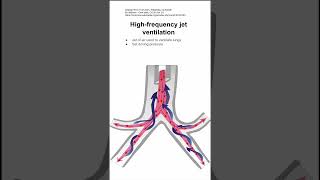 Highfrequency jet ventilation [upl. by Canty43]