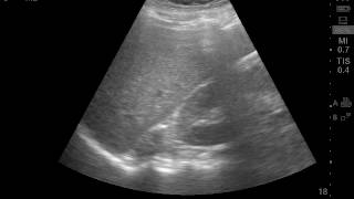 Right adrenal gland tumor [upl. by Aicnom]