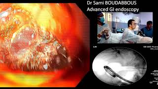 ERCP for severe acute cholangitis [upl. by Enelam]