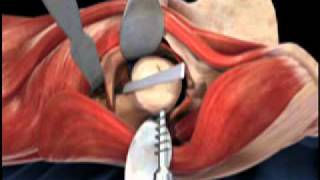 Femoral Head Osteotomy Animation  Direct Anterior Total Hip Replacement [upl. by Atteuqcaj476]