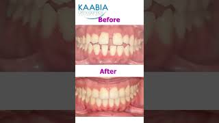 Bimaxillary protrusion  open bite and diastema [upl. by Annas]