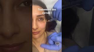 Traitement des cernes par acidehyaluronique raspaldo regard medecineesthetique [upl. by Iidnarb700]