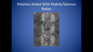 How to Read a Lumbar Spine Xray  Reading Standing Spine Xray [upl. by Leba]