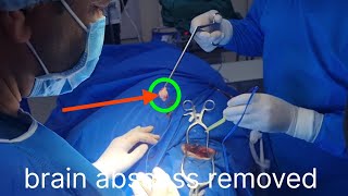 anesthesia for brain abscess induction intubation surgeryrecovery anesthesiology [upl. by Warp]