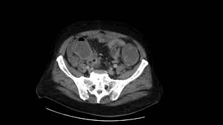 Sigmoid cancer with cecal perforation [upl. by Clarkson210]