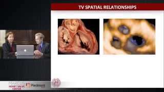 Echocardiographic Approach to the Tricuspid Valve 3D Echo 360 Conference [upl. by Naamann]