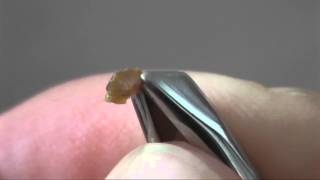 Wart Treatment Day4 Day 3 Is Recovery No Treatment [upl. by Sadoff]