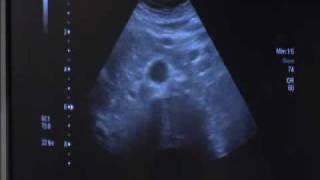 Abdominal Aorta Ultrasound  Conemaugh Physician Group Vascular Services [upl. by Kathie]