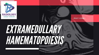 Extramedullary haematopoiesis Umamaheshwar Reddy V [upl. by Omsoc]