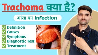 Trachoma Disease in Hindi  Causes Types Symptoms and Treatment of Trachoma [upl. by Carlile]