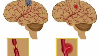 Difference Between Aneurysm and Blood Clot [upl. by Evans963]