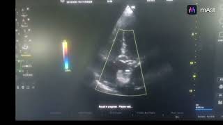 AKINETIC APICAL SEPTUM AND APEX MODERATE LV CONCENTRIC LVH GRADE I LV DIASTOLIC DYSFUNCTION [upl. by Lynn]