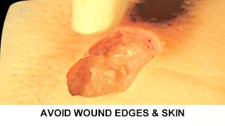 Enzymatic Debridement Demonstration Understand Wound Care [upl. by Reckford707]