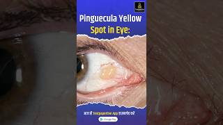 Pinguecula Yellow Spot in Eye Pinguecula eye testpaperlive [upl. by Aknaib]