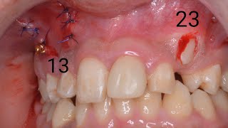 VISTA flap for impacted upper right canine using closed traction technique by Dr Ebrahim Elhadad [upl. by Aurthur]