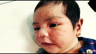 Neonatal cephalic pustulosis mimicking Neonatal Acne Erythema toxicum [upl. by Rocray]