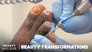 How Medical Pedicures Transform Feet [upl. by Aneehsak]